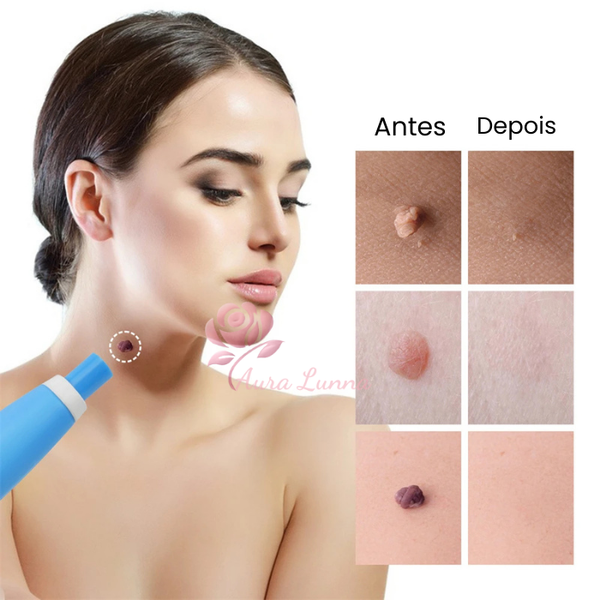 Caneta Removedora de verrugas